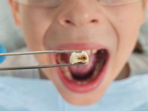 Best Broken or Chipped Tooth Repair in Mount Union, PA